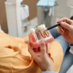 تصویر ایمپلنت دندان چقدر ماندگاری دارد