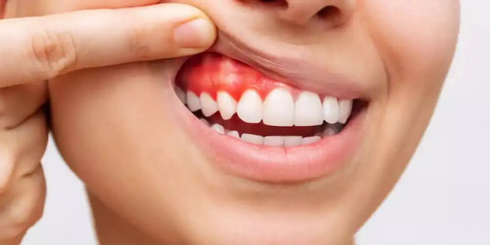 تاثیر التهاب و عفونت ایمپلنت دندان روی بوی بد دهان
