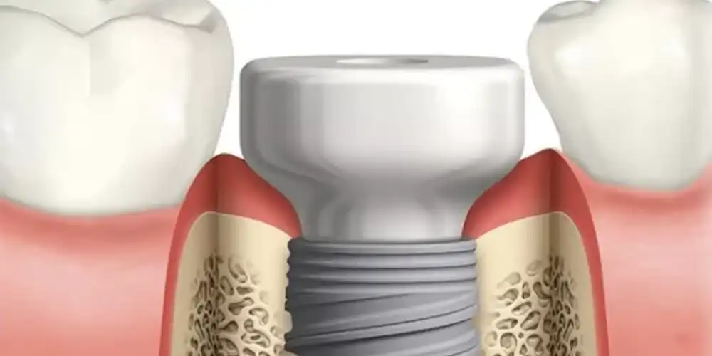 تصویر چگونه از باز شدن هیلینگ ایمپلنت جلوگیری کنیم؟