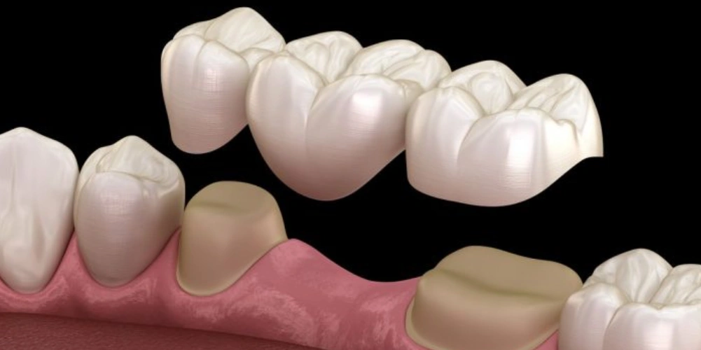 فلیپر دندان چیست و چه کاربردی دارد؟