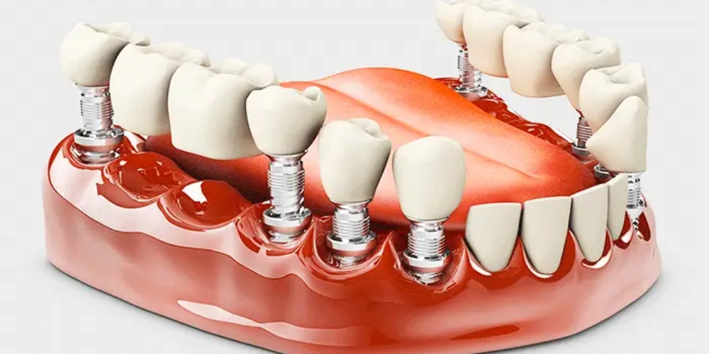 اهمیت استئواینتگریشن چیست؟