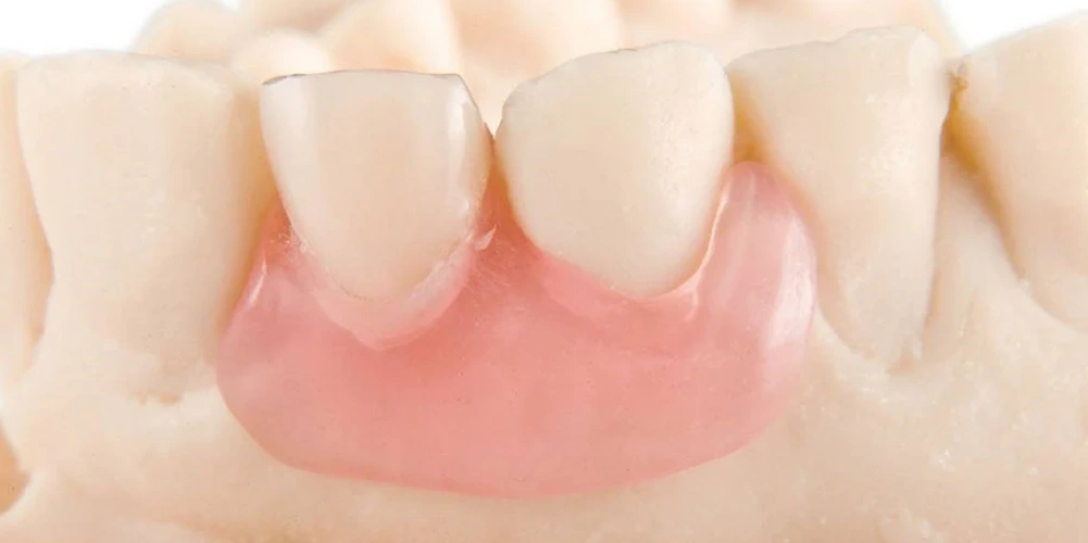 معایب فلیپر دندان چیست؟