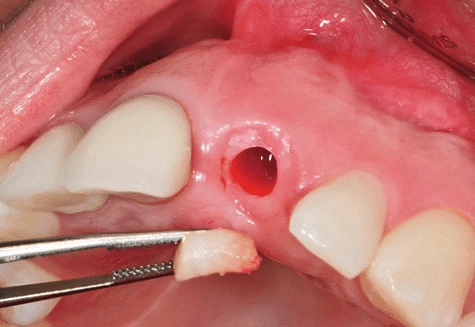ایمپلنت به روش پانچ چگونه است؟