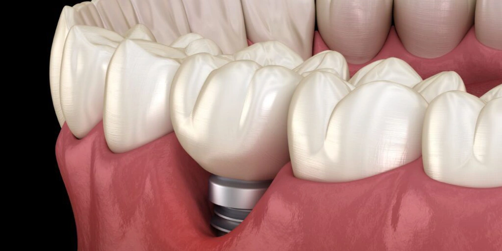 مقایسه ایمپلنت مینی با ایمپلنت معمولی