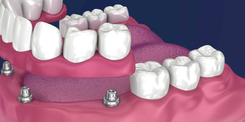 اوردنچر برای چه کسانی مناسب است؟
