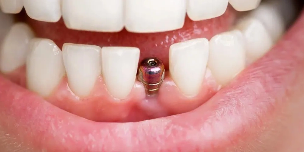 آشنایی با مینی ایمپلنت دندان