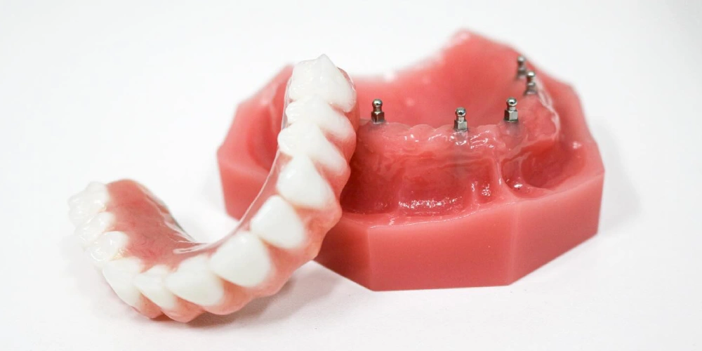 مینی ایمپلنت دندان چه مزایایی دارد؟