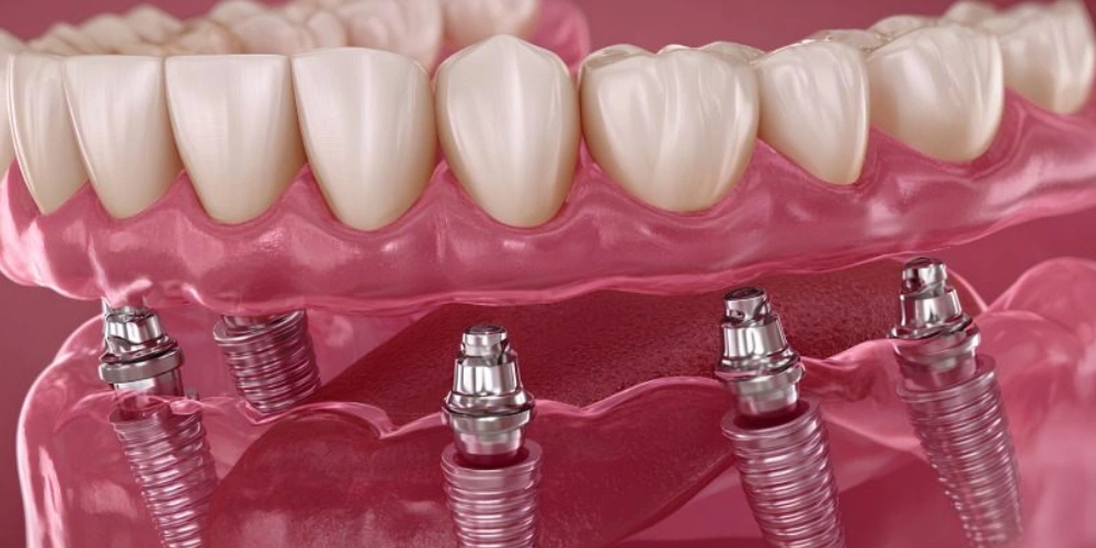 تفاوت اوردنچر با ایمپلنت دندان
