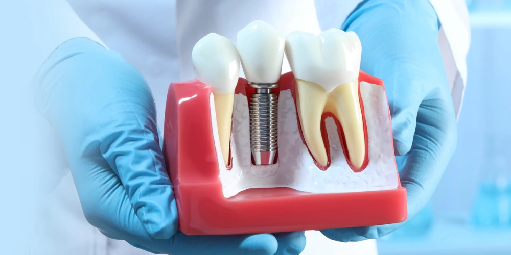 راه های جلوگیری از شکست ایمپلنت دندان