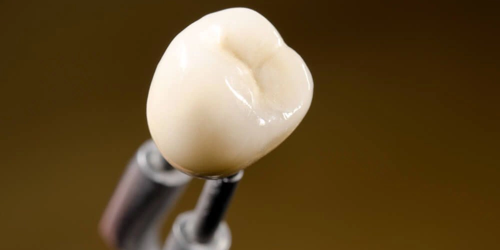 انواع روش های نصب روکش موقت ایمپلنت دندانی