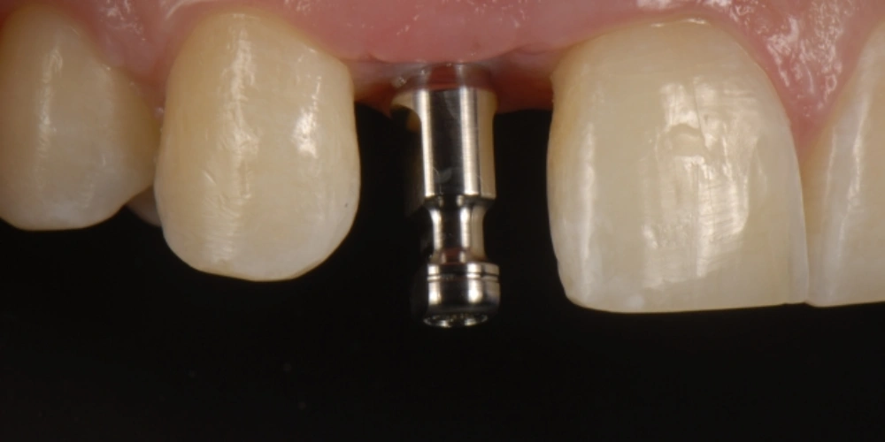 مراقبت های ضروری بعد از نصب روکش موقت ایمپلنت