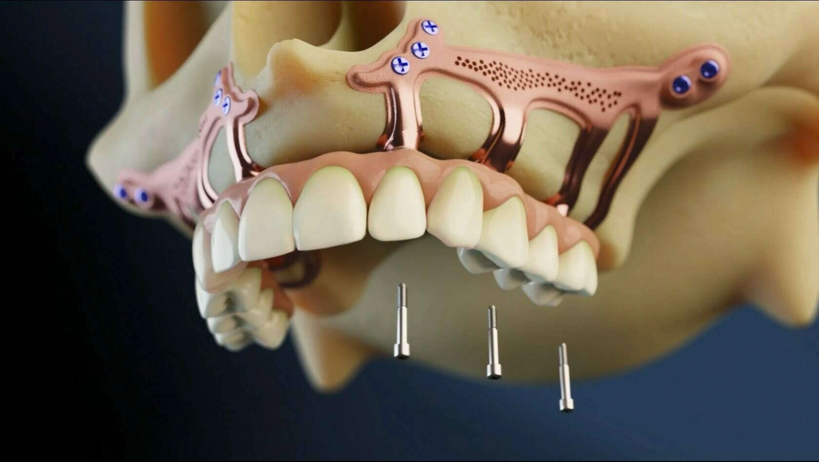 مزایا و معایب ایمپلنت ساب پریوستئال