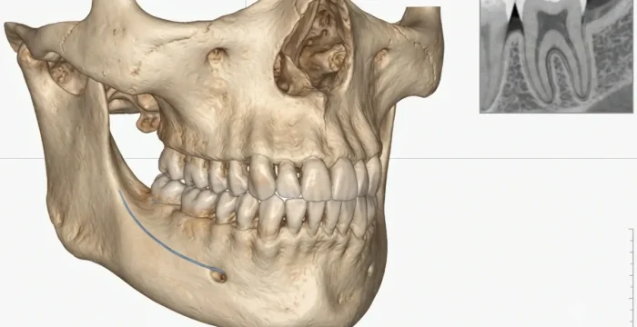 تصویربرداری سه‌بعدی CBCT و طراحی دقیق درمان