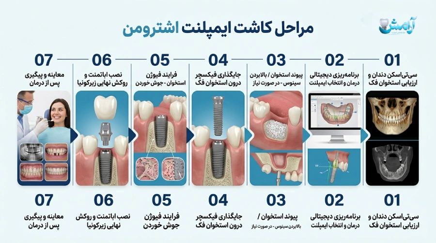 مراحل کاشت ایمپلنت اشترومن