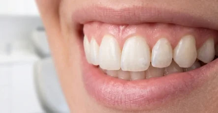 دلیل پوک شدن دندان چیست؟ بررسی علت‌ها و راه‌های جلوگیری و درمان