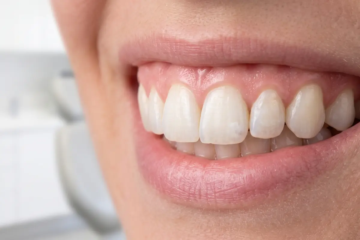 دلیل پوک شدن دندان چیست؟ بررسی علت‌ها و راه‌های جلوگیری و درمان